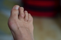 Hammertoe Deformities