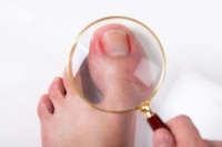 Managing an Ingrown Toenail