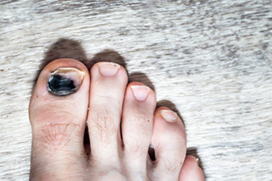 when-toenails-turn-black